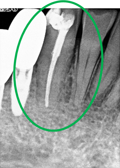 オールセラミック冠 治療前