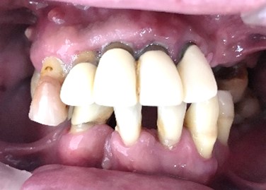 マグネット義歯