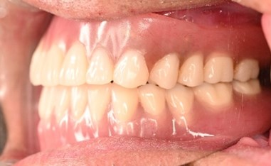 マグネット義歯