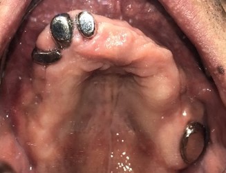 マグネット義歯