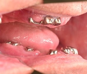 マグネット義歯