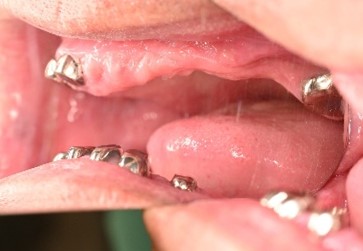 マグネット義歯