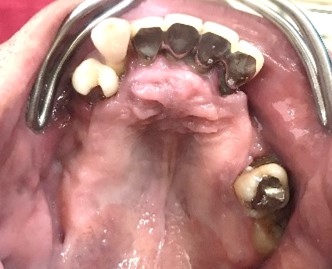 マグネット義歯