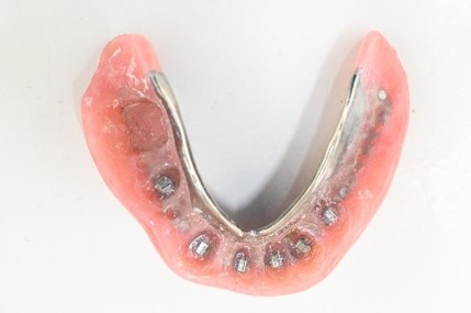 マグネット義歯