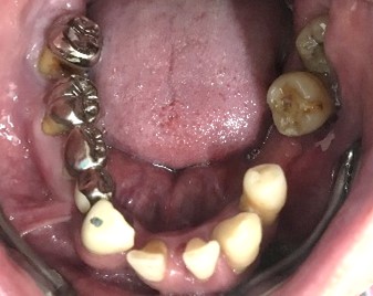 マグネット義歯