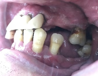 マグネット義歯