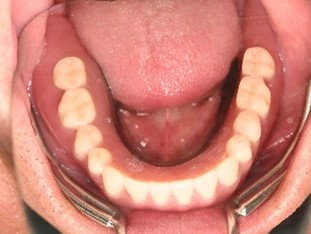 マグネット義歯