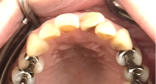 オールセラミック冠 治療前